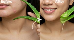 Acne Treatment At Home with Aloe Vera for Pimples &…