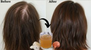 Onion Juice for Hair: Growth Benefits, Use, and Side Effects