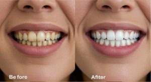 5 Natural Effective Ways to Whiten Teeth at Home